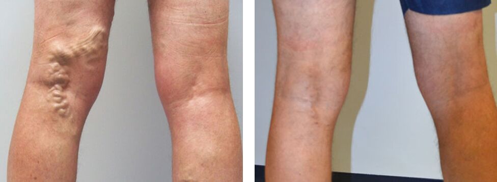 Fotos vor und nach der Verwendung von Veniselle, die Erfahrung der Verwendung der Creme