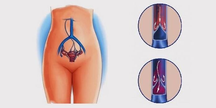 Krampfadern des Beckens